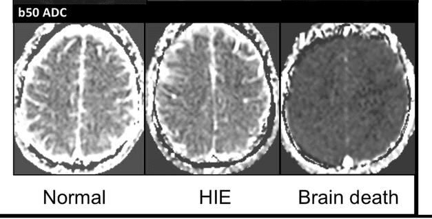 Brain scan progression showing Normal, HIE, and Brain Death